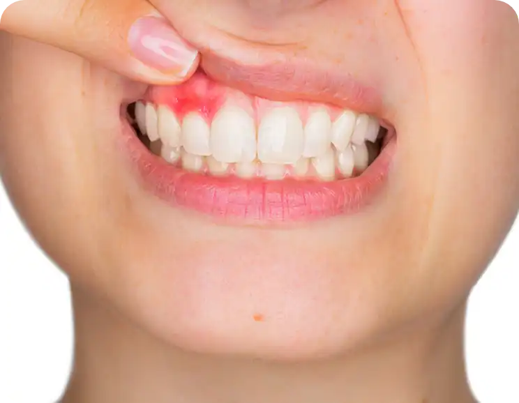 parodontologia-trattamenti-studio-dentistico-perrone-russo-roma